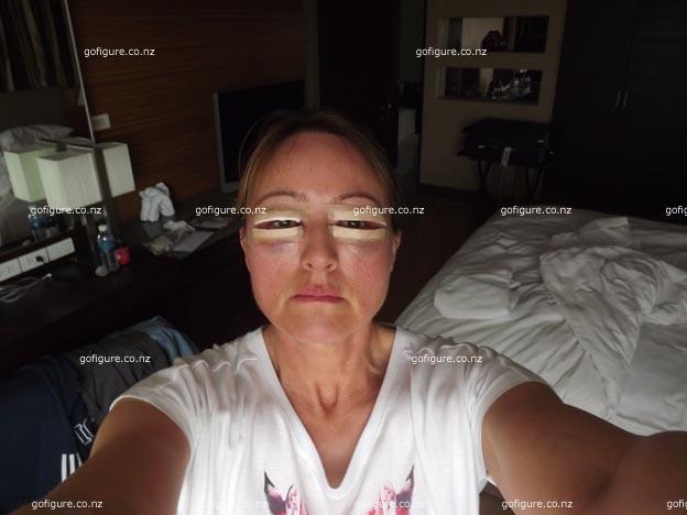 14-Lisa-postsurgery.jpg
